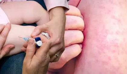 Kızamık vakaları her geçen gün artıyor, aşılama oranları ise düşüyor! Türkiye’de durum ne?